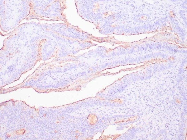 Immunohistochemistry (IHC) : Human colon carcinoma stained with anti-CA19-9 antibody using peroxidase-conjugate and DAB chromogen. Note cytoplasmic staining of tumor cells.