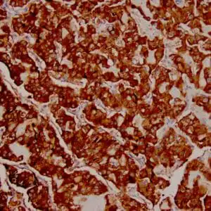 Immunohistochemistry (IHC) : Human thyroid medullary carcinoma stained with anti-Calcitonin antibody using peroxidase-conjugate and DAB. Note cytoplasmic staining of tumor cells.