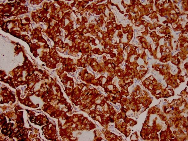 Immunohistochemistry (IHC) : Human thyroid medullary carcinoma stained with anti-Calcitonin antibody using peroxidase-conjugate and DAB. Note cytoplasmic staining of tumor cells.