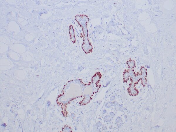 Immunohistochemistry (IHC) : Formalin-fixed, paraffin-embedded normal human breast tissue stained with anti-caldesmon antibody using peroxidase-conjugate and DAB chromogen. Note cytoplasmic staining of myoepithelial cells