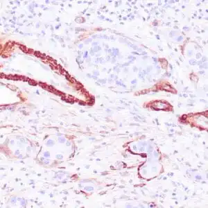 Immunohistochemistry (IHC) : Human breast ductal carcinoma in situ stained with anti-Calponin-1 antibody  using peroxidase-conjugate and DAB chromogen. Note cytoplasmic staining of myoepithelial cells.