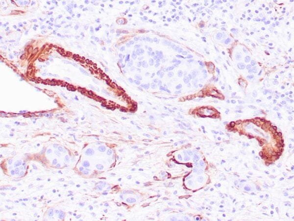 Immunohistochemistry (IHC) : Human breast ductal carcinoma in situ stained with anti-Calponin-1 antibody  using peroxidase-conjugate and DAB chromogen. Note cytoplasmic staining of myoepithelial cells.