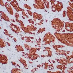Immunohistochemistry (IHC) : Formalin-fixed, paraffin-embedded human mesothelioma stained with anti-calretinin antibody using peroxidase-conjugate and DAB chromogen. Note cytoplasmic staining of mesothelioma cells