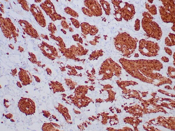 Immunohistochemistry (IHC) : Formalin-fixed, paraffin-embedded human mesothelioma stained with anti-calretinin antibody using peroxidase-conjugate and DAB chromogen. Note cytoplasmic staining of mesothelioma cells