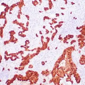 Immunohistochemistry (IHC) : Human mesothelioma stained with anti-calretinin antibody using peroxidase-conjugate and DAB chromogen. Note nuclear/cytoplasmic staining of mesothelioma cells.