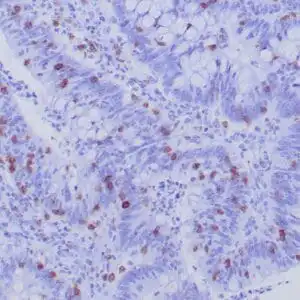 Immunohistochemistry (IHC) : Formalin-Fixed, paraffin-embedded human colon carcinoma stained with anti-CD103 antibody using peroxidase-conjugate and DAB chromogen. Note the cell surface staining of subset of T cells