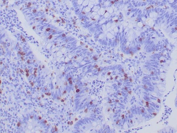 Immunohistochemistry (IHC) : Formalin-Fixed, paraffin-embedded human colon carcinoma stained with anti-CD103 antibody using peroxidase-conjugate and DAB chromogen. Note the cell surface staining of subset of T cells