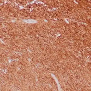 Immunohistochemistry (IHC) : Human GIST stained with anti-CD117 antibody using peroxidase-conjugate and DAB chromogen. Note cell membrane staining of tumor cells.