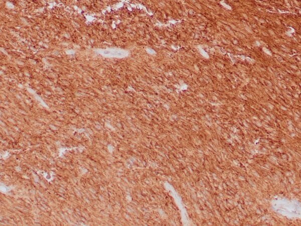 Immunohistochemistry (IHC) : Human GIST stained with anti-CD117 antibody using peroxidase-conjugate and DAB chromogen. Note cell membrane staining of tumor cells.