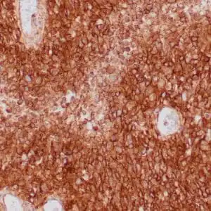 Immunohistochemistry (IHC) : Formalin-fixed, paraffin-embedded human GIST stained with anti-CD117 antibody using peroxidase-conjugate and DAB chromogen. Note cell membrane staining of tumor cells
