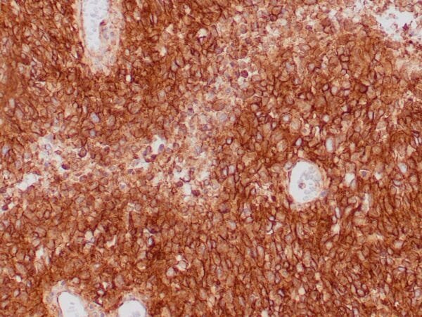 Immunohistochemistry (IHC) : Formalin-fixed, paraffin-embedded human GIST stained with anti-CD117 antibody using peroxidase-conjugate and DAB chromogen. Note cell membrane staining of tumor cells