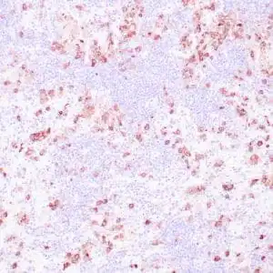 Immunohistochemistry (IHC) : Human Hodgkin lymphoma stained with anti-CD15 antibody using peroxidase conjugate and DAB chromogen. Note membranous staining of Reed-Sternberg cells.