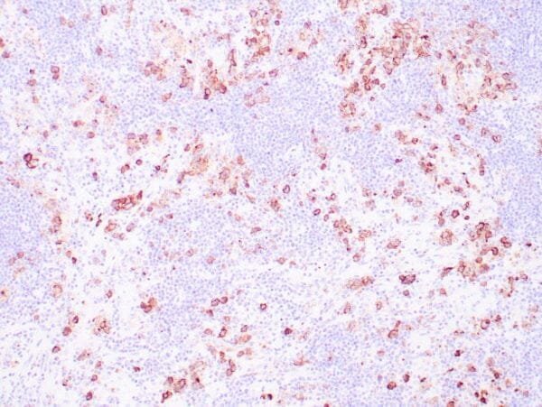 Immunohistochemistry (IHC) : Human Hodgkin lymphoma stained with anti-CD15 antibody using peroxidase conjugate and DAB chromogen. Note membranous staining of Reed-Sternberg cells.