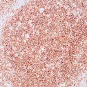Immunohistochemistry (IHC) : Human tonsil stained with anti-CD19 antibody using peroxidase-conjugate and DAB chromogen. Note the membranous staining of B-cells .
