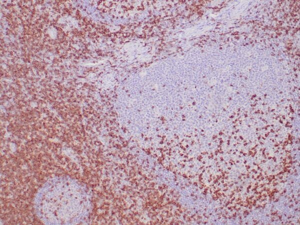 Immunohistochemistry (IHC) : Formalin-fixed, paraffin-embedded human tonsil stained with anti-CD2 antibody using peroxidase-conjugate and DAB chromogen. Note membrane and cytoplasmic staining of perifollicular T cells