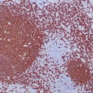 Immunohistochemistry (IHC) : Formalin-fixed, paraffin-embedded human lymph node stained with anti-CD20 antibody using peroxidase-conjugate and DAB chromogen. Note cell surface staining of B-cells.