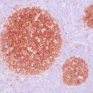 Immunohistochemistry (IHC) : Human lymph node stained with anti-CD20 antibody using peroxidase-conjugate and DAB chromogen. Note the membrane and cytoplasmic staining of B-cells in mantle and follicle.