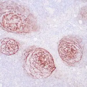 Immunohistochemistry (IHC) : Human tonsil stained with anti-CD21 antibodyusing peroxidase-conjugate and DAB chromogen.  Note the membrane staining of follicular dendritic cells in follicles.