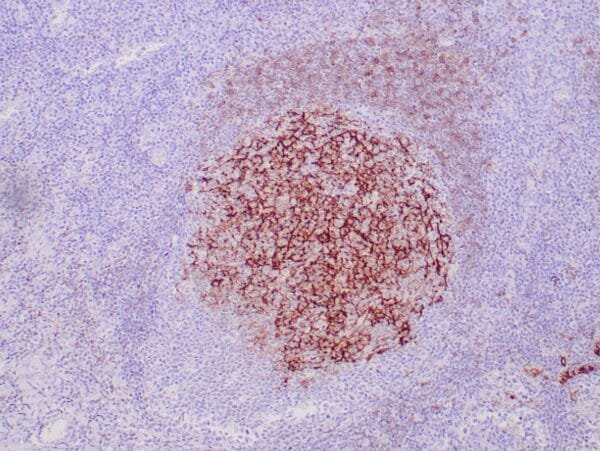 Immunohistochemistry (IHC) : Formalin-fixed, paraffin-embedded human tonsil stained with anti-CD23 antibody using peroxidase-conjugate and DAB chromogen. Note the membranous staining of follicular dendritic cells