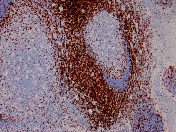 Immunohistochemistry (IHC) : Formalin-fixed, paraffin-embedded human lymph node stained with anti-CD3 antibody using peroxidase-conjugate and DAB chromogen. Note the membranous staining of perifollicular T-cells and no stain in B-cells