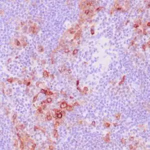 Immunohistochemistry (IHC) : Human Hodgkin lymphoma stained with anti-CD30 antibody using peroxidase-conjugate and DAB chromogen.  Note the membranous staining of Hodgkin’s cells.