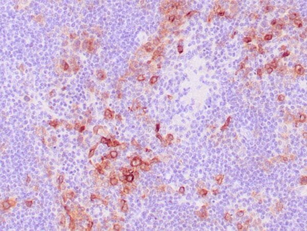 Immunohistochemistry (IHC) : Human Hodgkin lymphoma stained with anti-CD30 antibody using peroxidase-conjugate and DAB chromogen.  Note the membranous staining of Hodgkin’s cells.