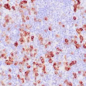 Immunohistochemistry (IHC) : Human Hodgkin lymphoma stained with anti-CD30 antibody using peroxidase-conjugate and DAB chromogen.  Note the membranous staining of Hodgkin’s cells.