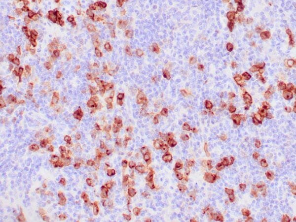 Immunohistochemistry (IHC) : Human Hodgkin lymphoma stained with anti-CD30 antibody using peroxidase-conjugate and DAB chromogen.  Note the membranous staining of Hodgkin’s cells.