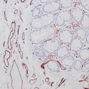 Immunohistochemistry (IHC) : Formalin-fixed, paraffin-embedded human colon stained with anti-CD31 antibody using peroxidase-conjugate and DAB chromogen. Note cell surface and cytoplasmic staining of vascular endothelial cells .