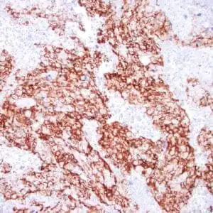 Immunohistochemistry (IHC) : Human angiosarcoma stained with anti-CD31 antibody using peroxidase-conjugate and DAB chromogen. Note cytoplasmic staining of tumor cells.