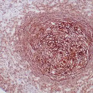 Immunohistochemistry (IHC) : Formalin-fixed, paraffin-embedded human tonsil stained with anti-CD35 antibody using peroxidase-conjugated and DAB chromogen. Note cell surface staining of follicular dendritic cells