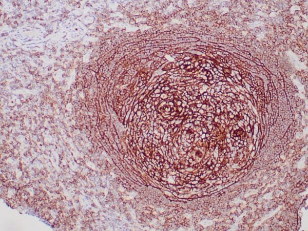 Immunohistochemistry (IHC) : Formalin-fixed, paraffin-embedded human tonsil stained with anti-CD35 antibody using peroxidase-conjugated and DAB chromogen. Note cell surface staining of follicular dendritic cells