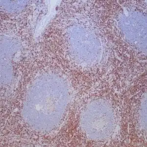 Immunohistochemistry (IHC) : Formalin-fixed, paraffin-embedded human tonsil stained with anti-CD43 antibody using peroxidase-conjugate and DAB chromogen. Note the cell membrane staining of perifollicular T-cells