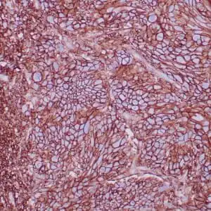 Immunohistochemistry (IHC) : Formalin-fixed, paraffin-embedded human squamous cell carcinoma stained with anti-CD44 using   peroxidase-conjugate and DAB chromogen. Note the cell membrane staining of tumor cells