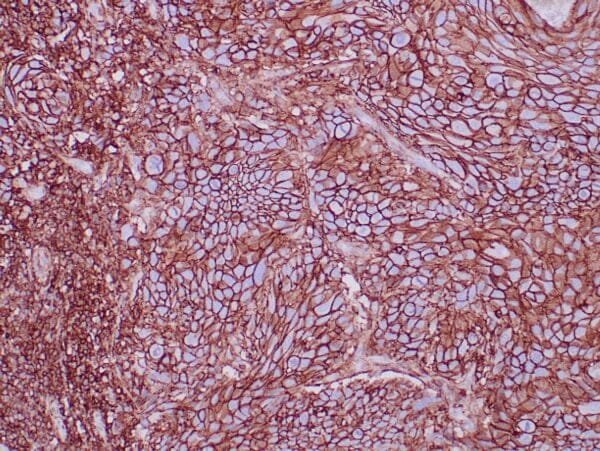 Immunohistochemistry (IHC) : Formalin-fixed, paraffin-embedded human squamous cell carcinoma stained with anti-CD44 using   peroxidase-conjugate and DAB chromogen. Note the cell membrane staining of tumor cells