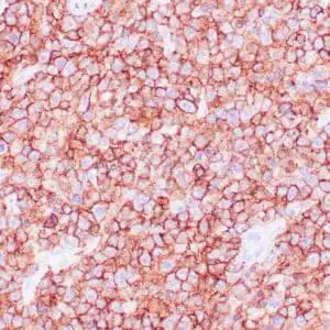 Immunohistochemistry (IHC) : Human diffuse large B cell lymphoma stained with anti-CD45/RB (LCA) antibody using peroxidase-conjugate and DAB chromogen. Note cell membrane staining of lymphoma cells.