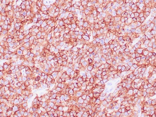 Immunohistochemistry (IHC) : Human diffuse large B cell lymphoma stained with anti-CD45/RB (LCA) antibody using peroxidase-conjugate and DAB chromogen. Note cell membrane staining of lymphoma cells.