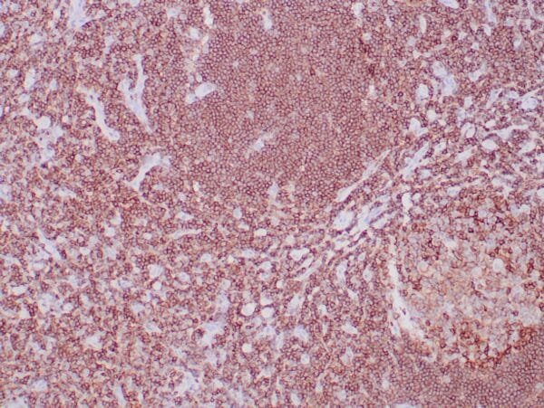 Immunohistochemistry (IHC) : Formalin-fixed, paraffin-embedded human lymph node stained with anti-CD45 (LCA) antibody using  peroxidase-conjugate and DAB chromogen. Note cell membrane staining of B- and T-lymphocytes.