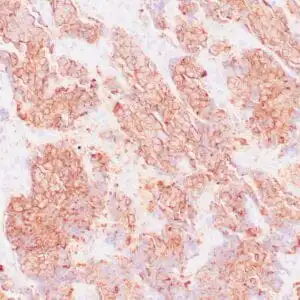 Immunohistochemistry (IHC) : Human neuroendocrine carcinoma stained with anti-CD56 antibody using peroxidase-conjugate and DAB chromogen. Note cell membrane staining of tumor cells.
