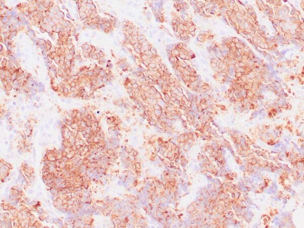 Immunohistochemistry (IHC) : Human neuroendocrine carcinoma stained with anti-CD56 antibody using peroxidase-conjugate and DAB chromogen. Note cell membrane staining of tumor cells.