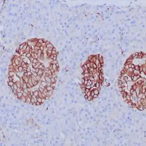Immunohistochemistry (IHC) : Human neuroendocrine carcinoma stained with anti-CD56 antibody using peroxidase-conjugate and DAB chromogen. Note cell membrane staining of tumor cells.