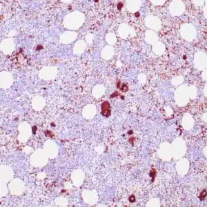 Immunohistochemistry (IHC) : Human bone marrow stained with anti-CD61 antibody using peroxidase-conjugate and DAB chromogen. Note the cytoplasmic staining of megakaryocytes.