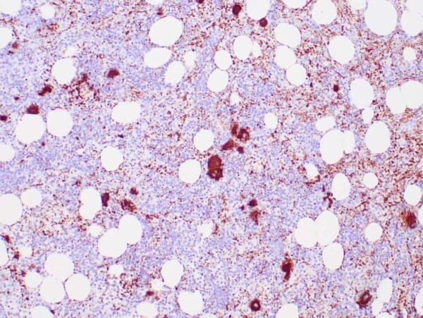 Immunohistochemistry (IHC) : Human bone marrow stained with anti-CD61 antibody using peroxidase-conjugate and DAB chromogen. Note the cytoplasmic staining of megakaryocytes.