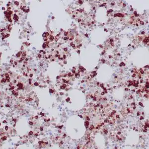Immunohistochemistry (IHC) : Formalin-fixed, paraffin-embedded bone marrow stained with anti-CD71 antibody using peroxidase-conjugated and DAB chromogen. Note the cytoplasmic staining of erythroid precursors