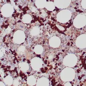 Immunohistochemistry (IHC) : Formalin-fixed, paraffin-embedded bone marrow stained with anti-CD71 antibody using peroxidase-conjugated and DAB chromogen. Note the cytoplasmic staining of erythroid precursors