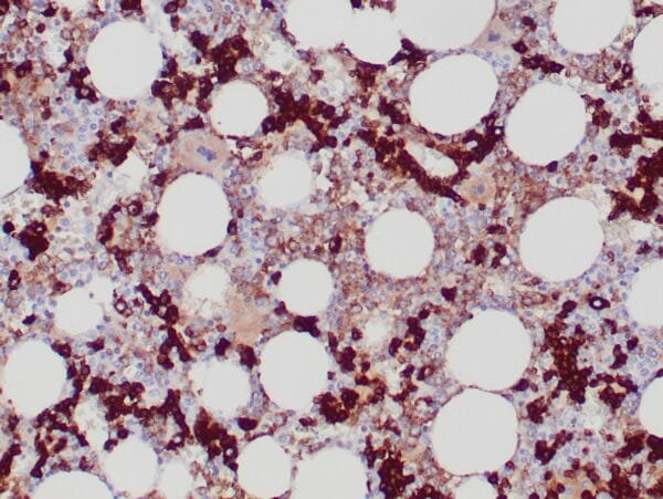 Immunohistochemistry (IHC) : Formalin-fixed, paraffin-embedded bone marrow stained with anti-CD71 antibody using peroxidase-conjugated and DAB chromogen. Note the cytoplasmic staining of erythroid precursors