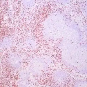 Immunohistochemistry (IHC) : Human tonsil stained with anti-CD8 antibody using peroxidase-conjugate and DAB chromogen. Not the membrane staining of perifollicular T-cells.