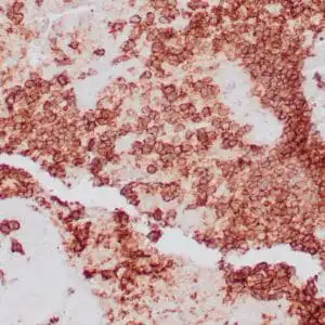 Immunohistochemistry (IHC) : Formalin-fixed, paraffin-embedded human Ewing’s sarcoma stained with clone ZR423 antibody using peroxidase-conjugate and DAB chromogen. Note the cell membrane staining of tumor cells