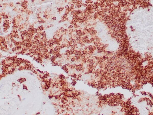 Immunohistochemistry (IHC) : Formalin-fixed, paraffin-embedded human Ewing’s sarcoma stained with clone ZR423 antibody using peroxidase-conjugate and DAB chromogen. Note the cell membrane staining of tumor cells