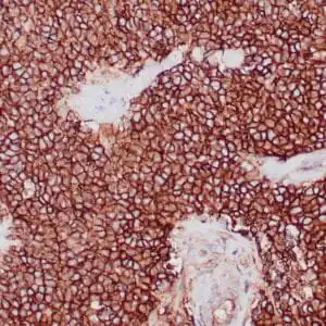 Immunohistochemistry (IHC) : Formalin-fixed, paraffin-embedded human Ewing’s sarcoma stained with clone ZM139 antibody using peroxidase-conjugate and DAB chromogen. Note the cell membrane staining of tumor cells